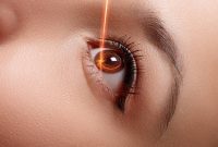 Ilustrasi prosedur operasi LASIK menggunakan teknologi laser untuk memperbaiki kelainan refraksi pada mata, sehingga membantu meningkatkan kualitas penglihatan dan mengurangi ketergantungan terhadap kacamata maupun lensa kontak.