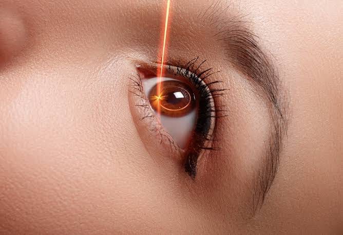 Ilustrasi prosedur operasi LASIK menggunakan teknologi laser untuk memperbaiki kelainan refraksi pada mata, sehingga membantu meningkatkan kualitas penglihatan dan mengurangi ketergantungan terhadap kacamata maupun lensa kontak.